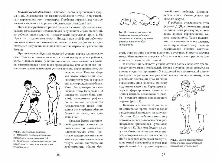 Méthodes d'électrothérapie de la DЦП