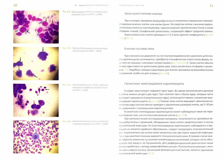 Цитопатология кожи. Probablement Canca