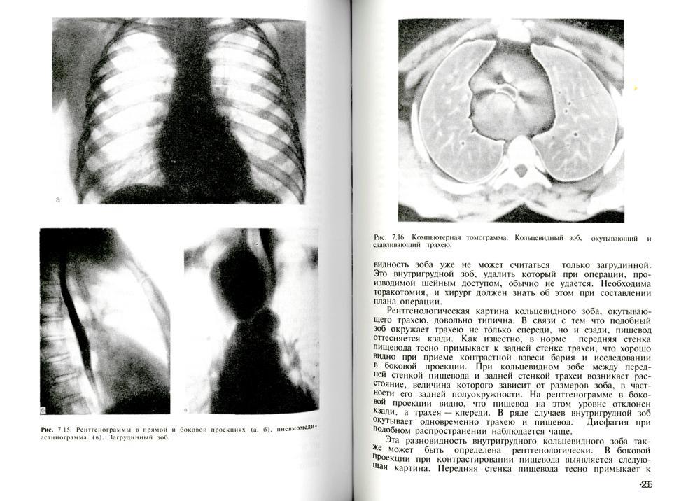 Дифференциальная рентгенодиагностика заболеваний органов дыхания и средостения. Т. 2 (репринтное изд.)