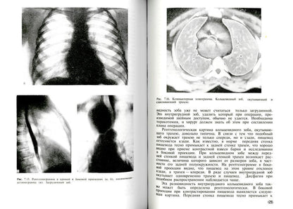 Дифференциальная рентгенодиагностика заболеваний органов дыхания и средостения. Т. 2 (репринтное изд.)