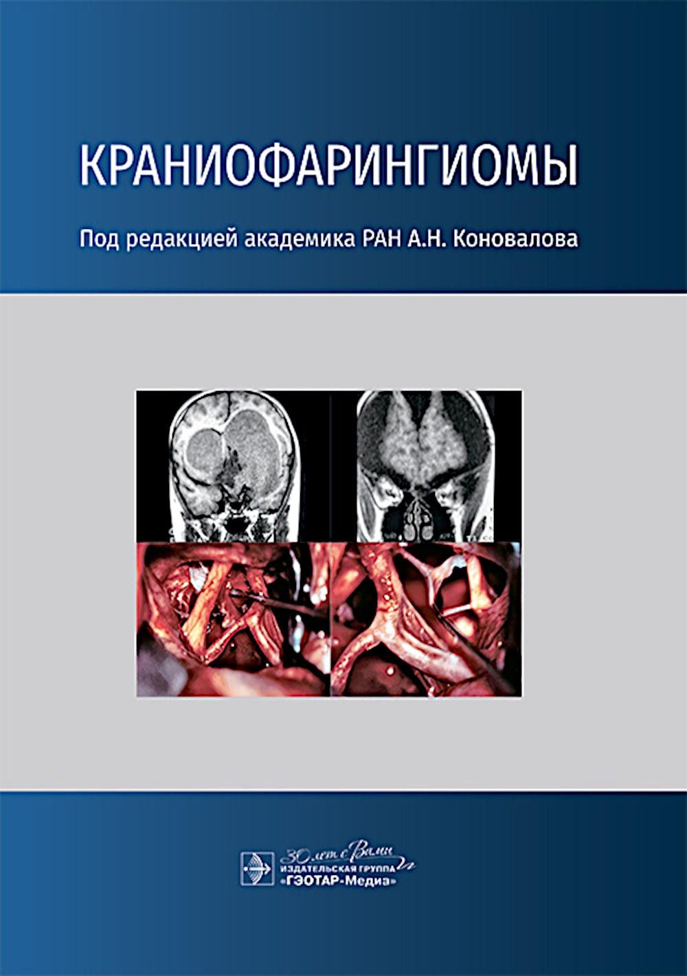 Краниофарингиомы / под ред. A. H. Коновалова. — Москва : ГЭОТАР-Медиа, 2025. — 160 с. : IL.