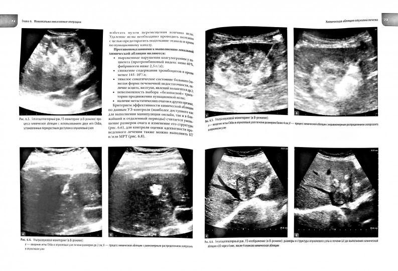 Атлас операций при злокачественных опухолях печени и поджелудочной железы (билиопанкретодуоденальной зоны). Под ред. Каприна А.Д., Кубышкин В.А.