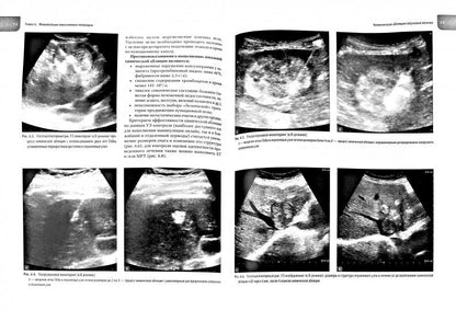 Атлас операций при злокачественных опухолях печени и поджелудочной железы (билиопанкретодуоденальной зоны). Под ред. Каприна А.Д., Кубышкин В.А.