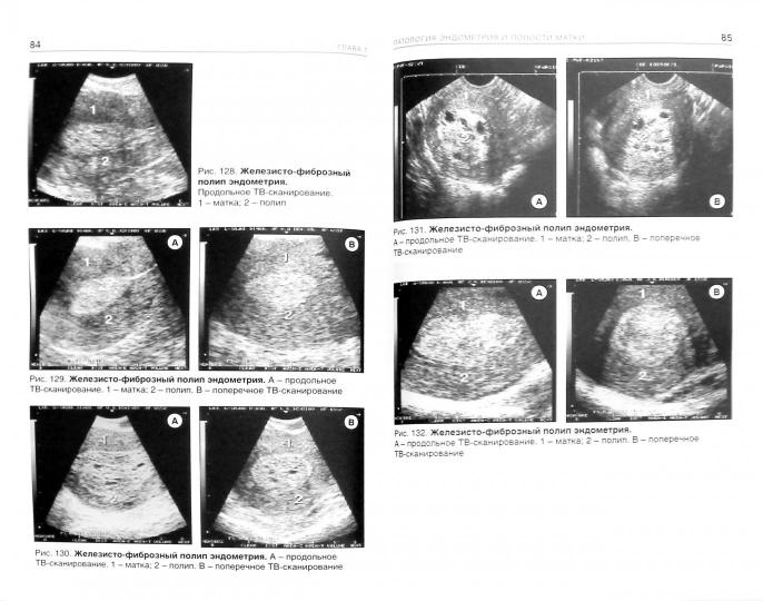 Эхография органов малого таза у женщин. Вып. IV. Патология полости матки и эндометрия. ВМК: практическое пособие. Демидов В.Н.