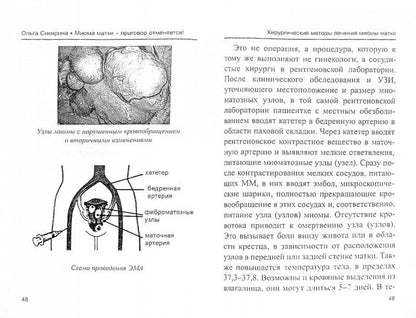 Миома матки - приговор отменяется!