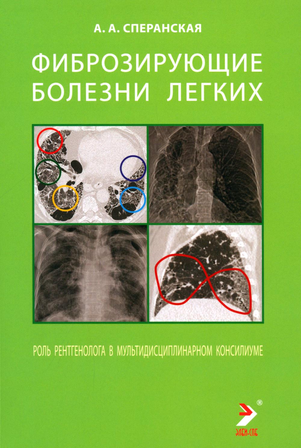 Фиброзирующие болезни легких. Rôle de rentgénologie dans le conseil multidisciplinaire