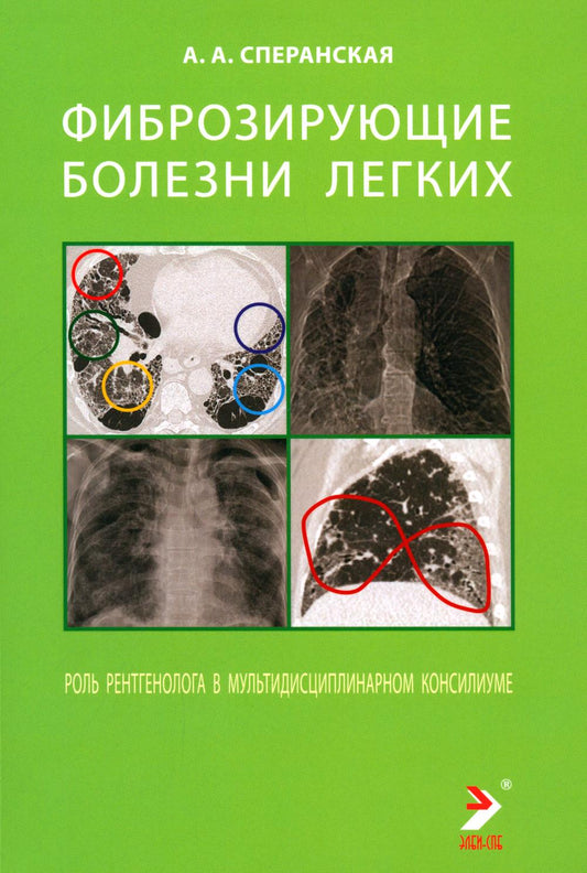 Фиброзирующие болезни легких. Rôle de rentgénologie dans le conseil multidisciplinaire