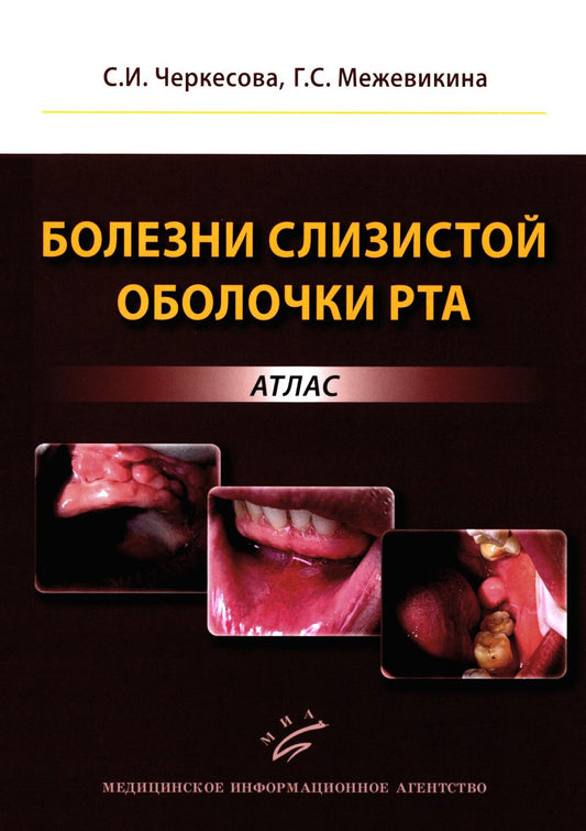 Болезни слизистой оболочки рта: atlas