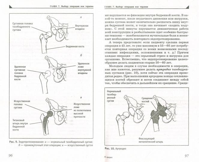 Артроз.Избавляемся от болей в суставах