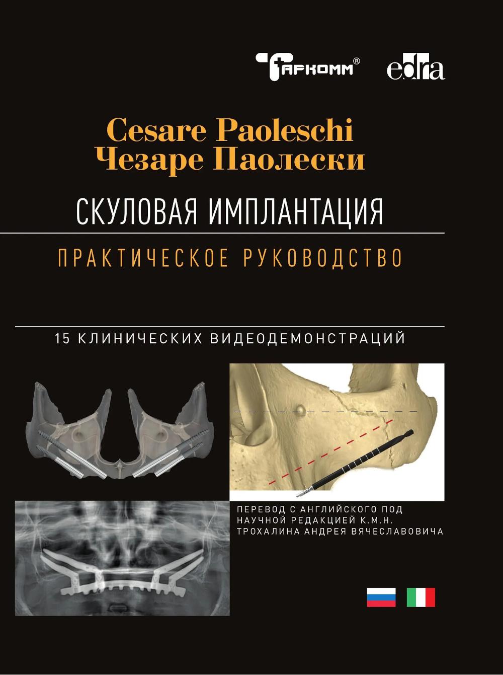Скуловая имплантация. Практическое руководство - Чезаре Паолески