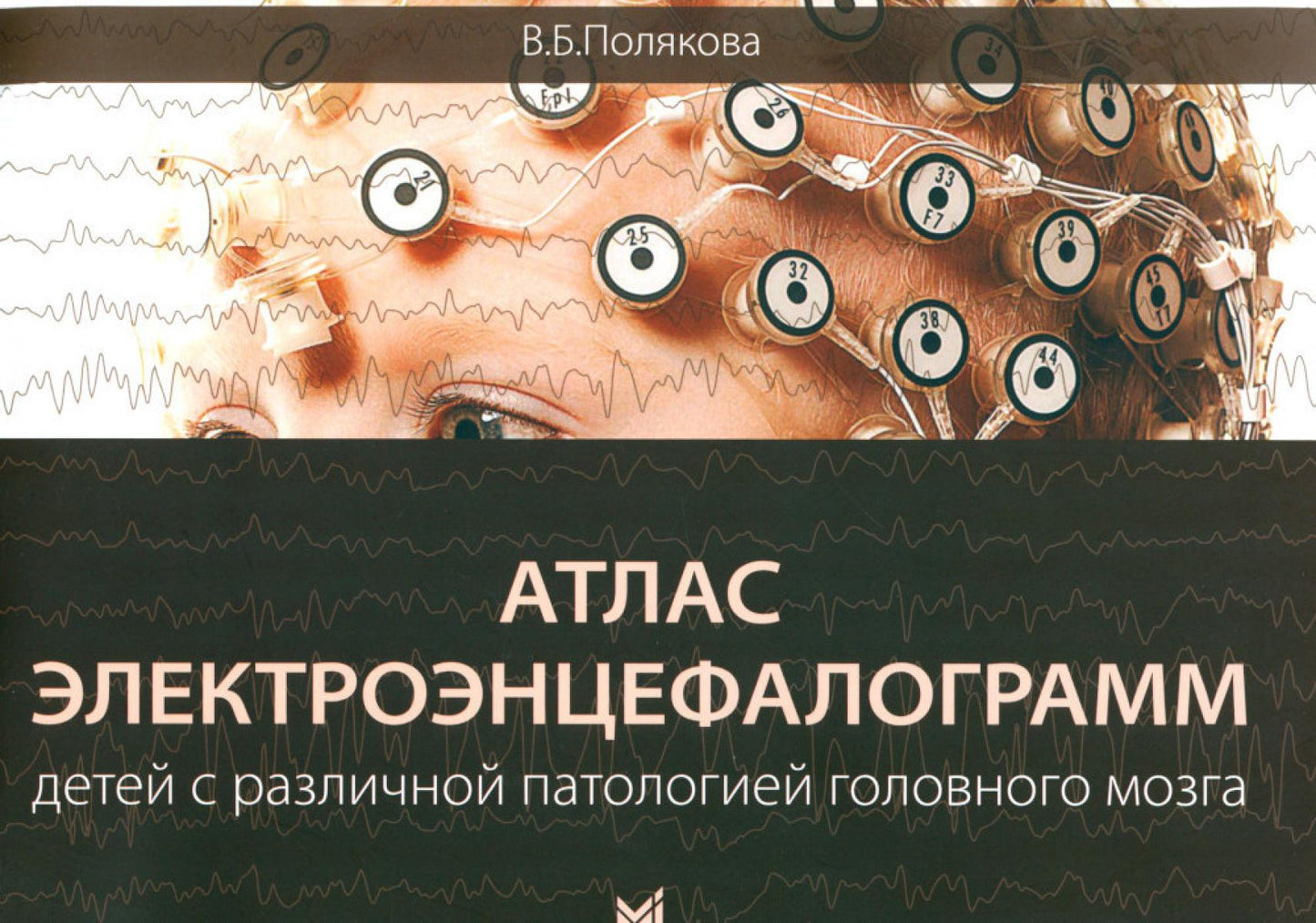 L'électrographe du bébé d'Atlas est en contact avec la pathologie la plus proche. 2-e jour